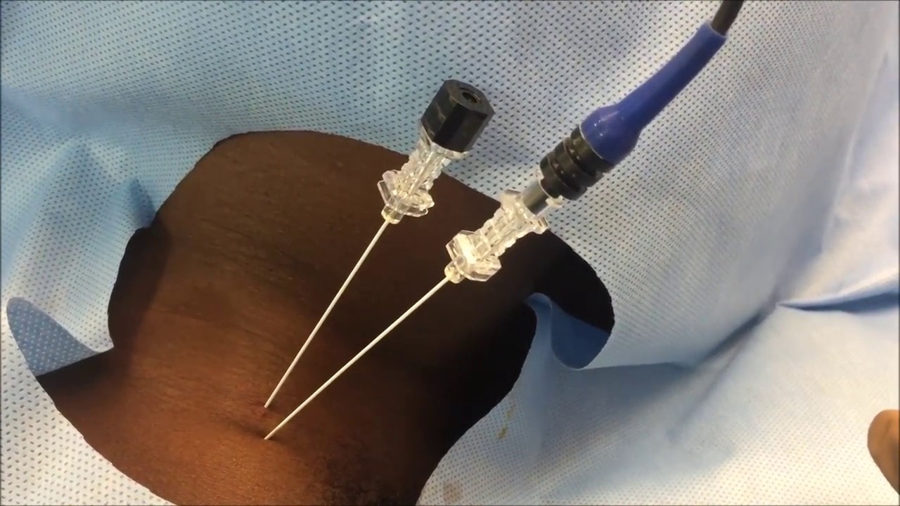 Cervical 3rd occipital nerve and medial branch radiofrequency ablation ...