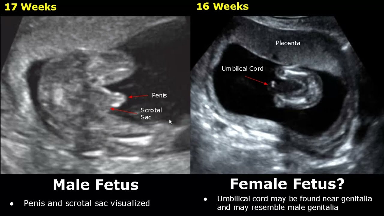 24 Weeks Ultrasound Gender