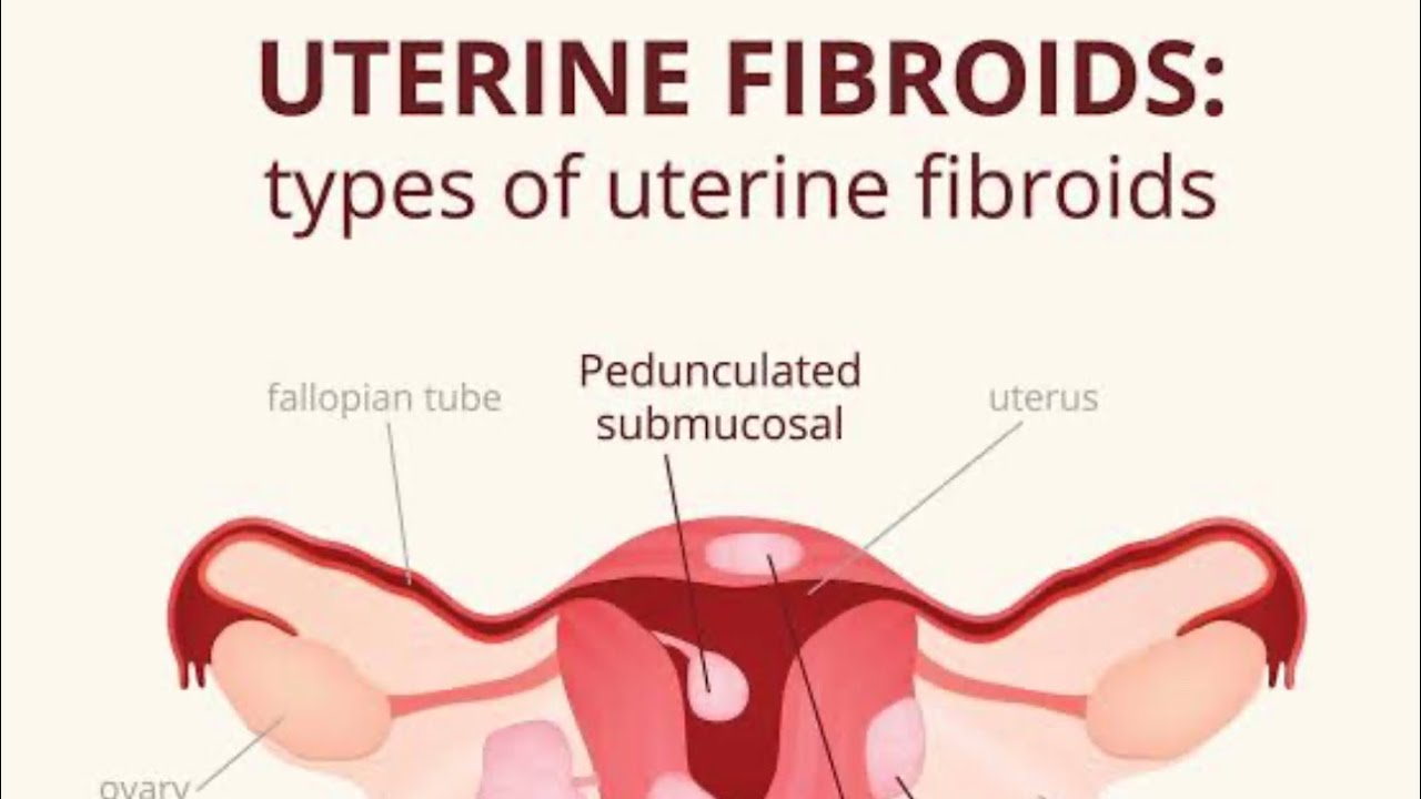 Fibroid , Benign conditions of myometrim #gynaecology #gynae # ...