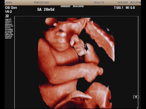 Fetus 29 weeks, clenched hand, FGR, VSD, polyhyramnios - YouTube