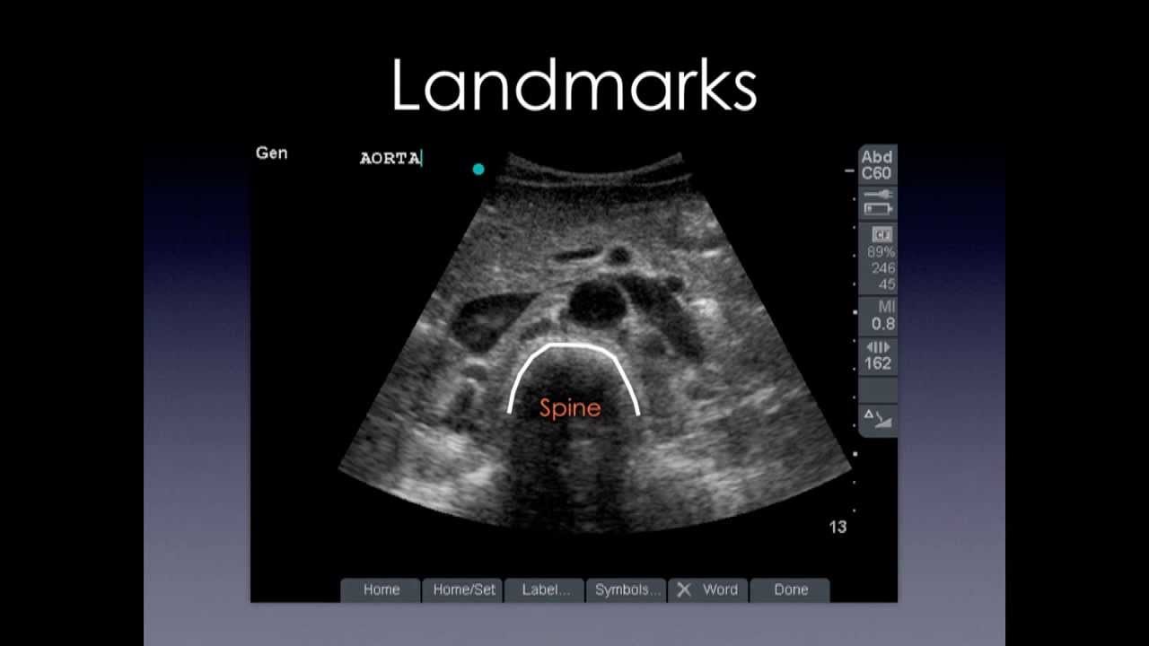 Aorta Anatomy Ultrasound