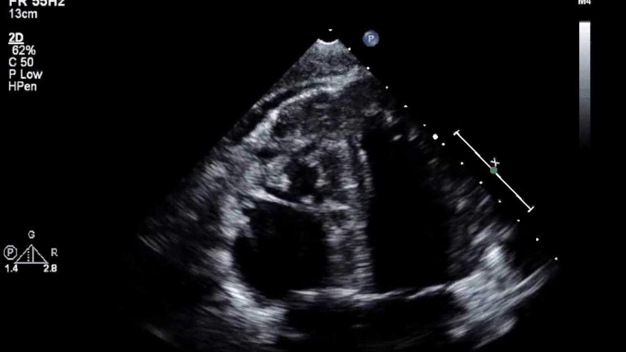 Arrhythmogenic Right Ventricular Dysplasia Echo