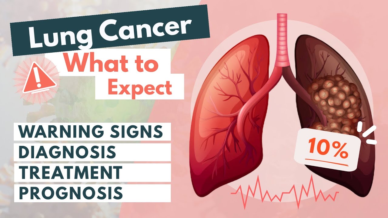 Lung cancer: What to expect? | Symptoms, Diagnosis, Treatment ...