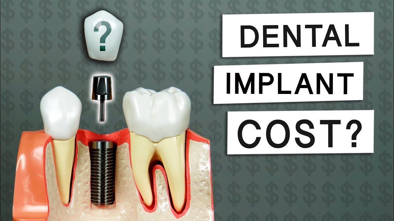 How Much Do Dental Implants Cost?