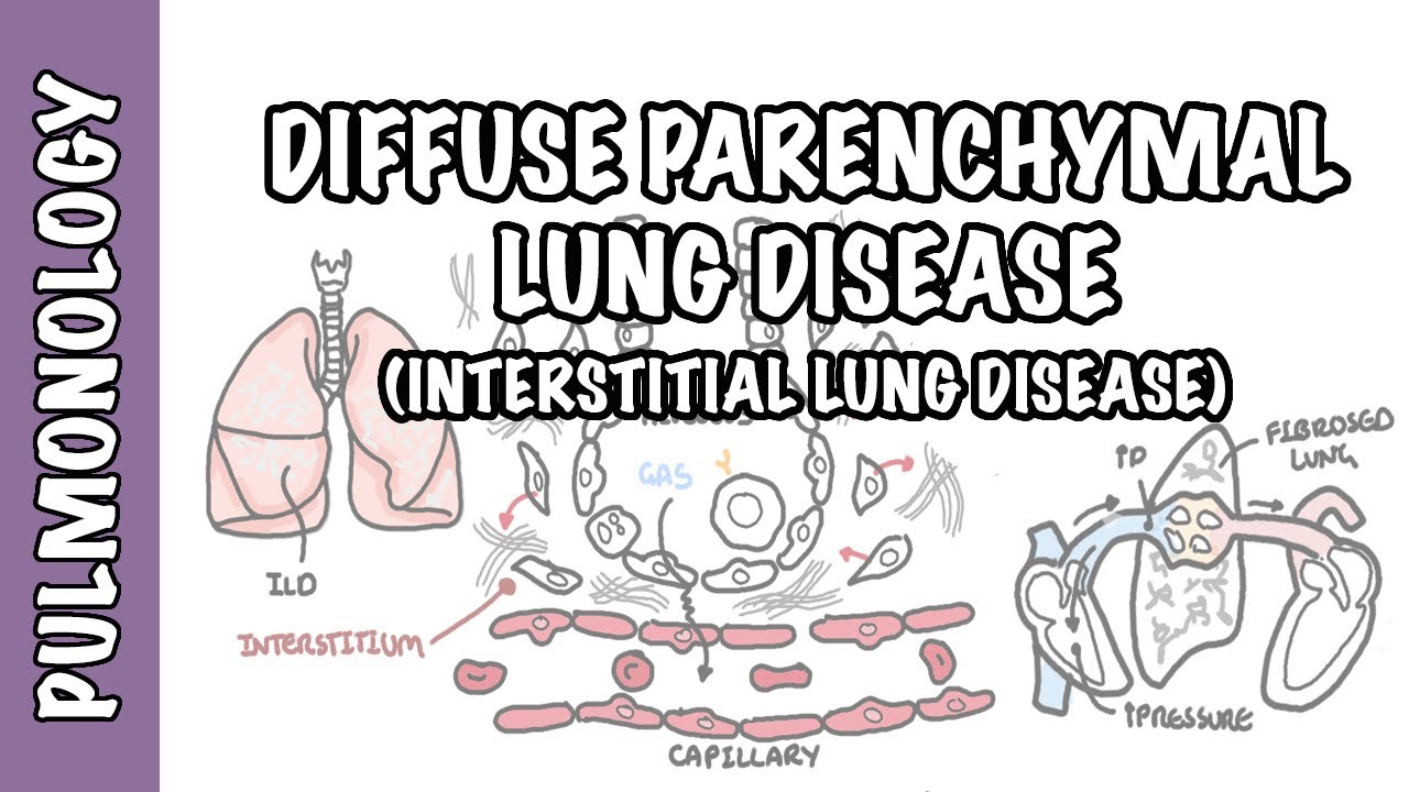 Interstitial Lung Disease (ILD) - Classification, pathophysiology ...