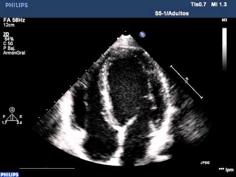 Ecocardiograma Doppler - YouTube