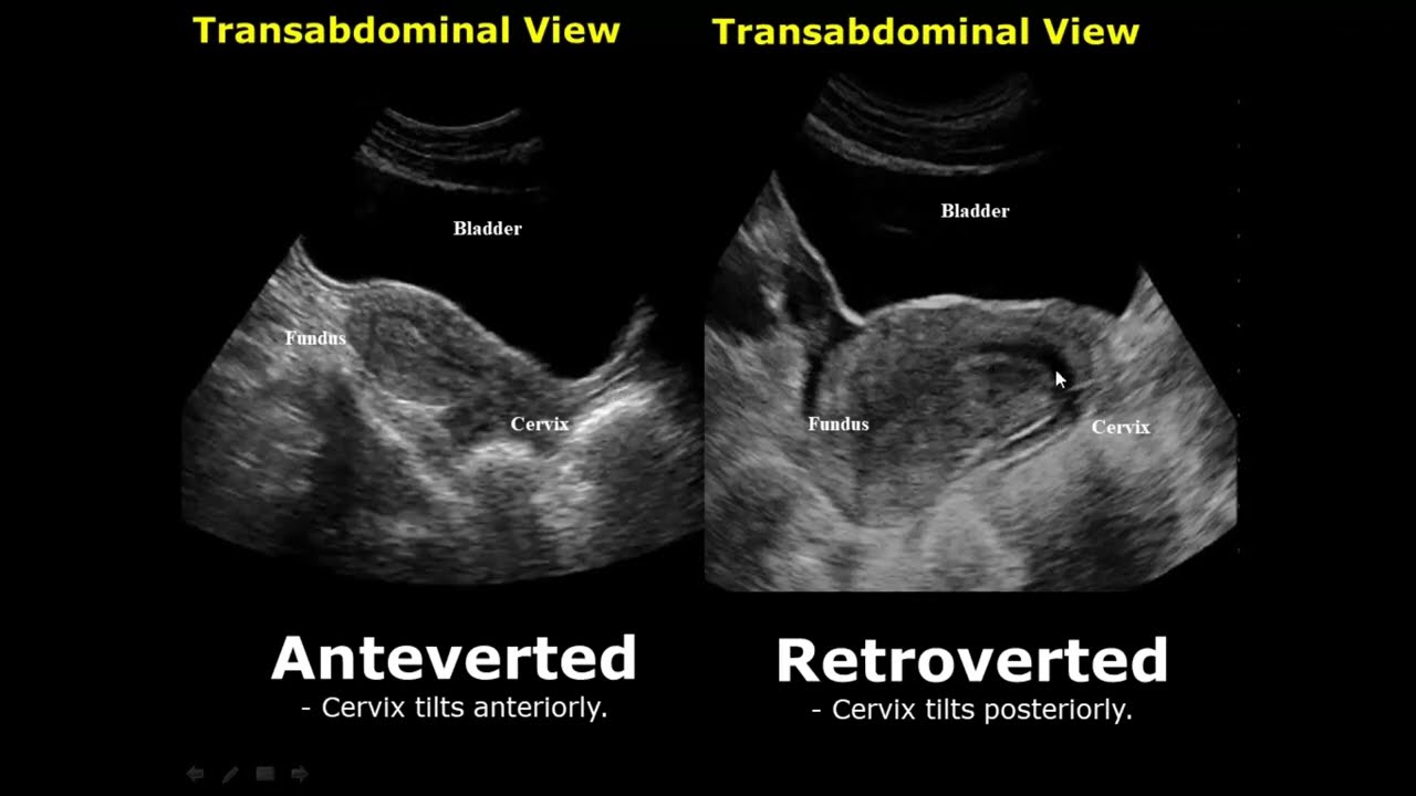 Inverted Uterus