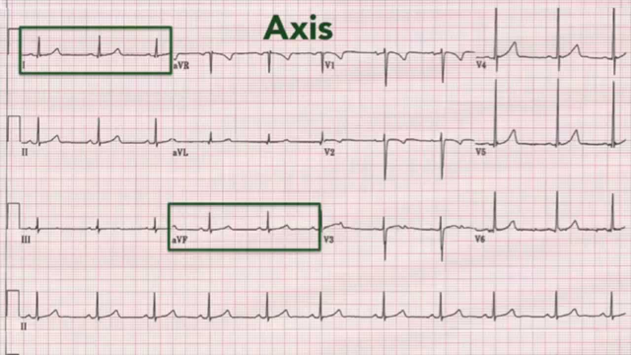 Normal Ecg