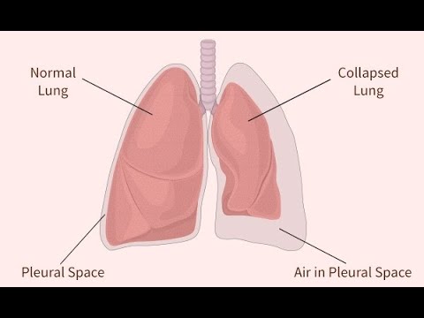 Pneumothorax Segmentation - YouTube