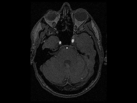 MRT nach Schlaganfall / MRI after ischemic stroke - YouTube