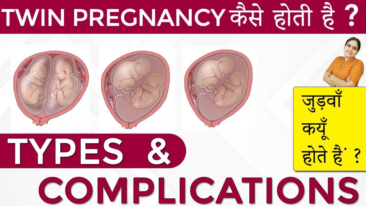 DCDA TWIN PREGNANCY IN HINDI| DCDA TWINS MEANING|, 56% OFF