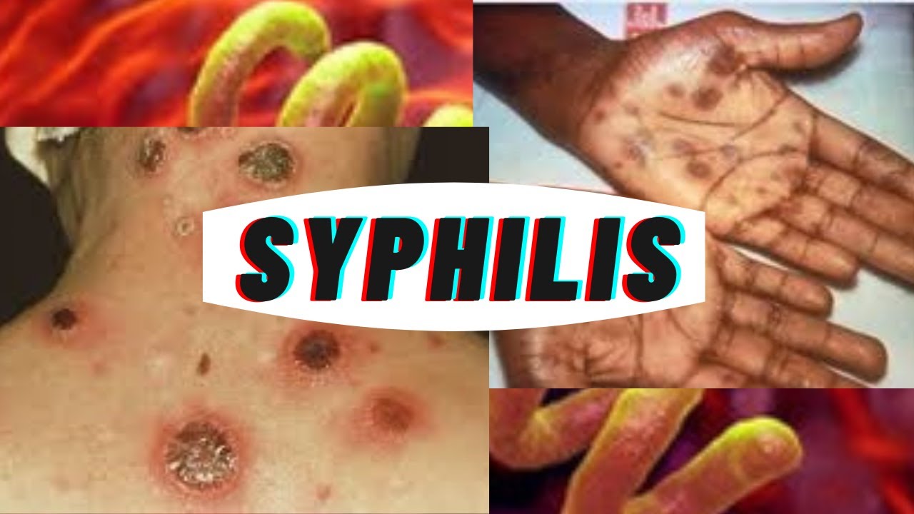 What is Syphilis | Stages of syphilis infection | causes of syphilis ...