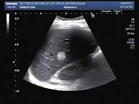 Hepatic Hemangioma Ultrasound