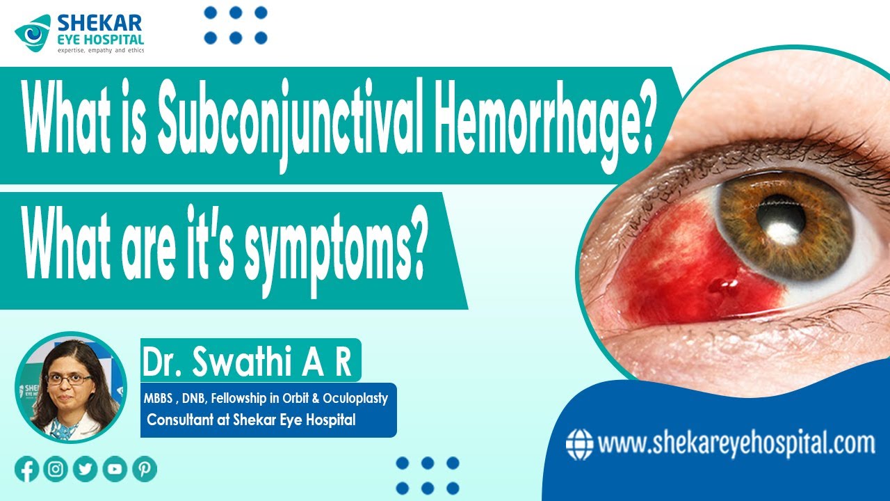 Subconjunctival Hemorrhage