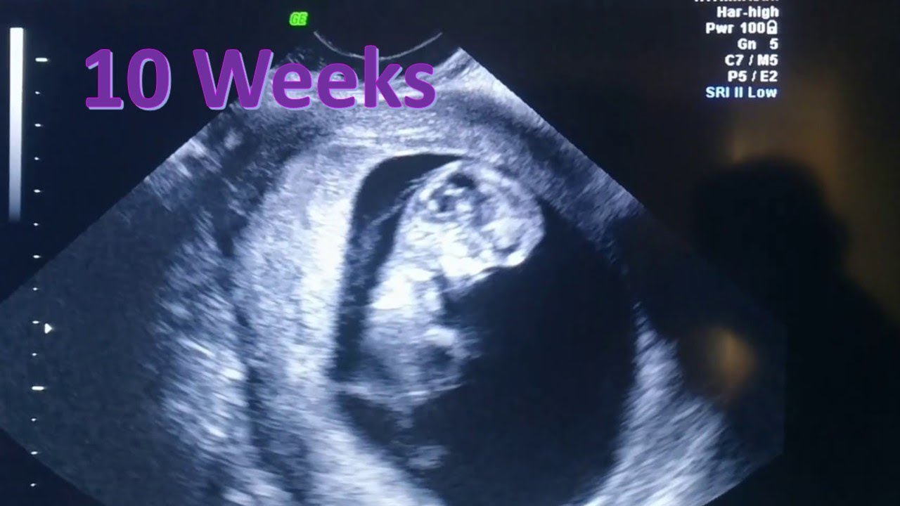 10 Weeks Pregnant Ultrasound