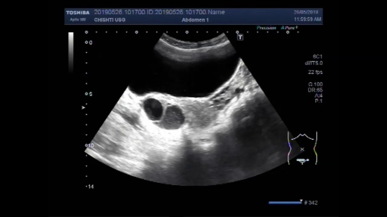 Simple Ovarian Cyst Ultrasound