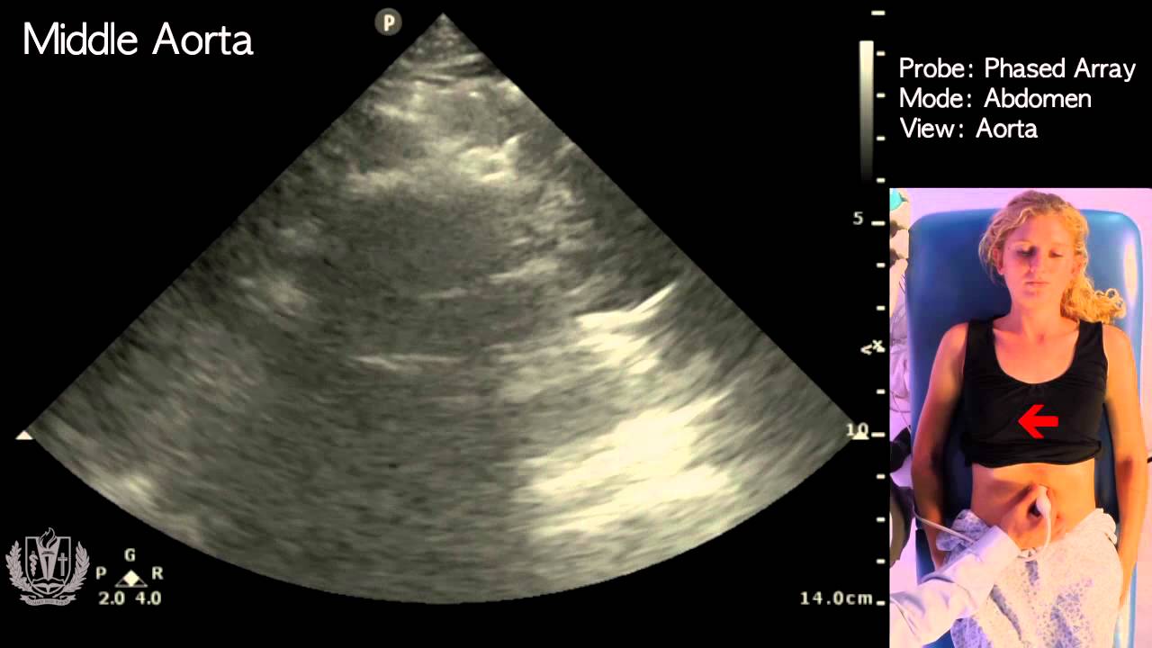 Aorta Ultrasound