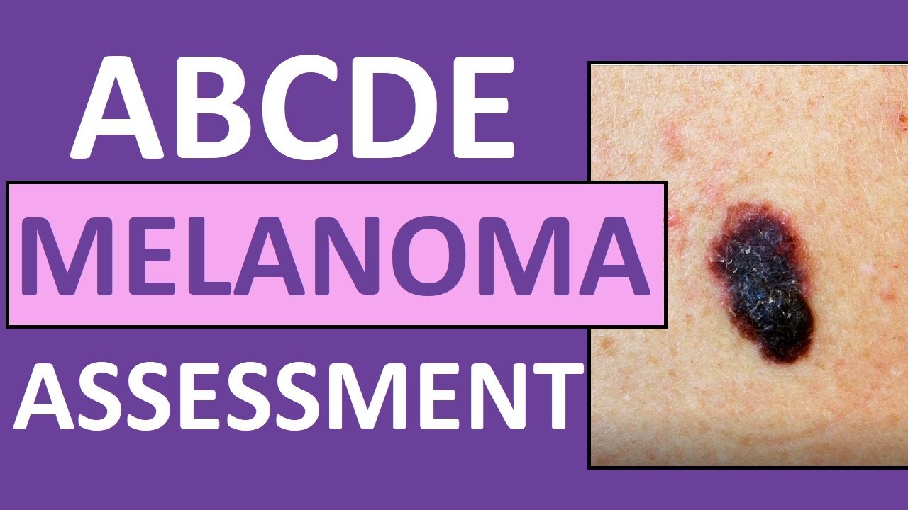 Malignant Melanoma Abcde