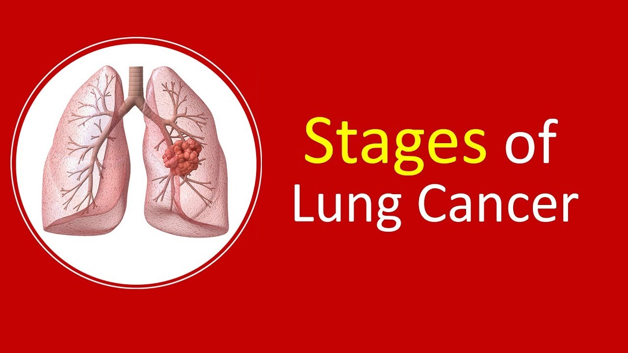 Stages of Lung Cancer - Dr. (Prof.) Arvind Kumar - YouTube