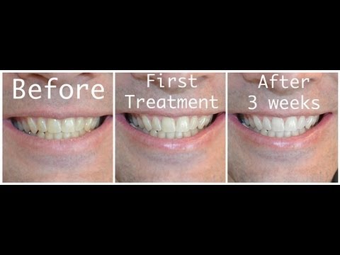 Is hydrogen peroxide teeth whitening