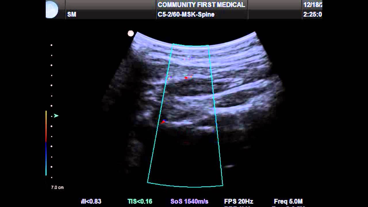 Occipital Nerve Block