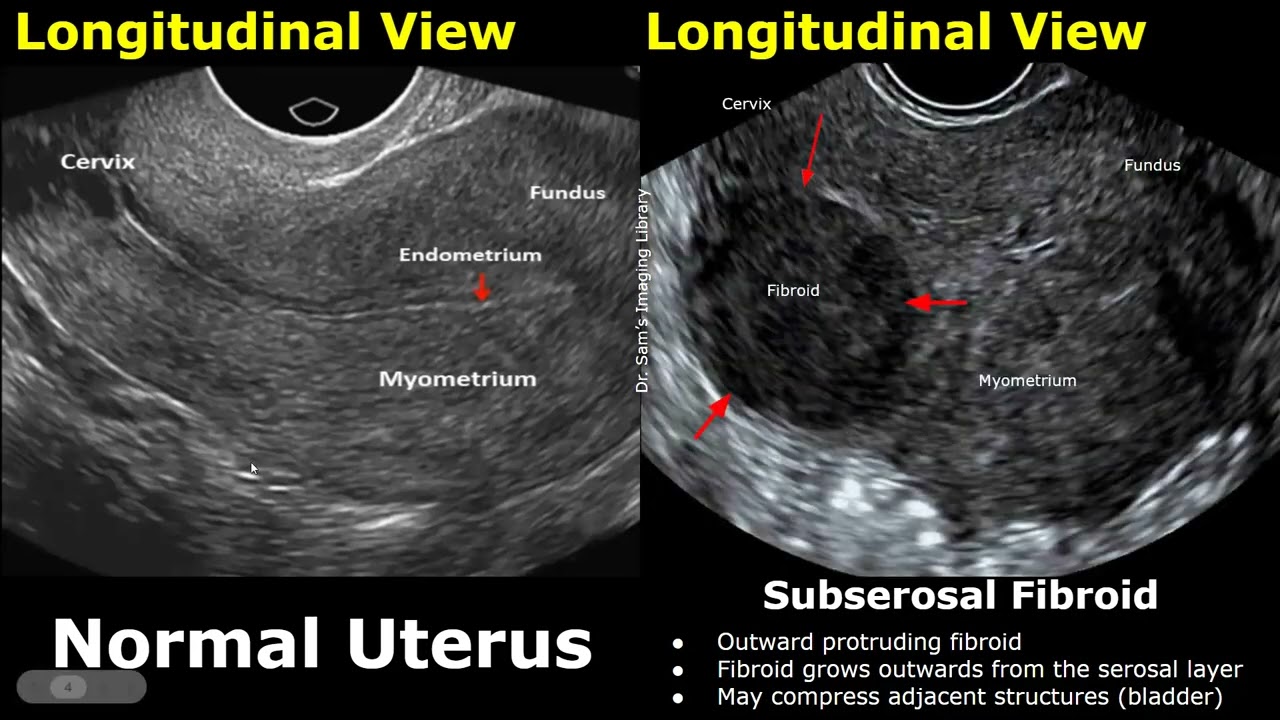 Uterus Fibroid Ultrasound