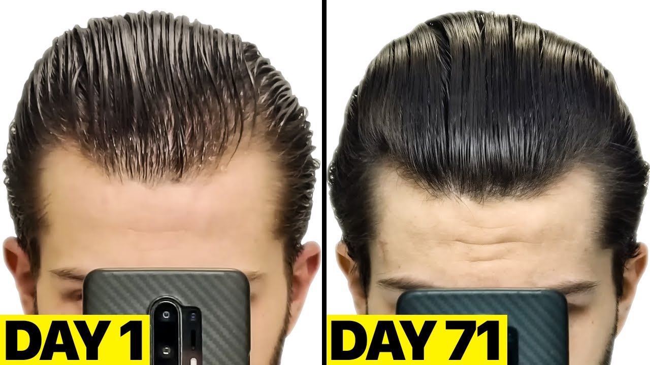 My INSANE Finasteride & Minoxidil 2.5 Months Results