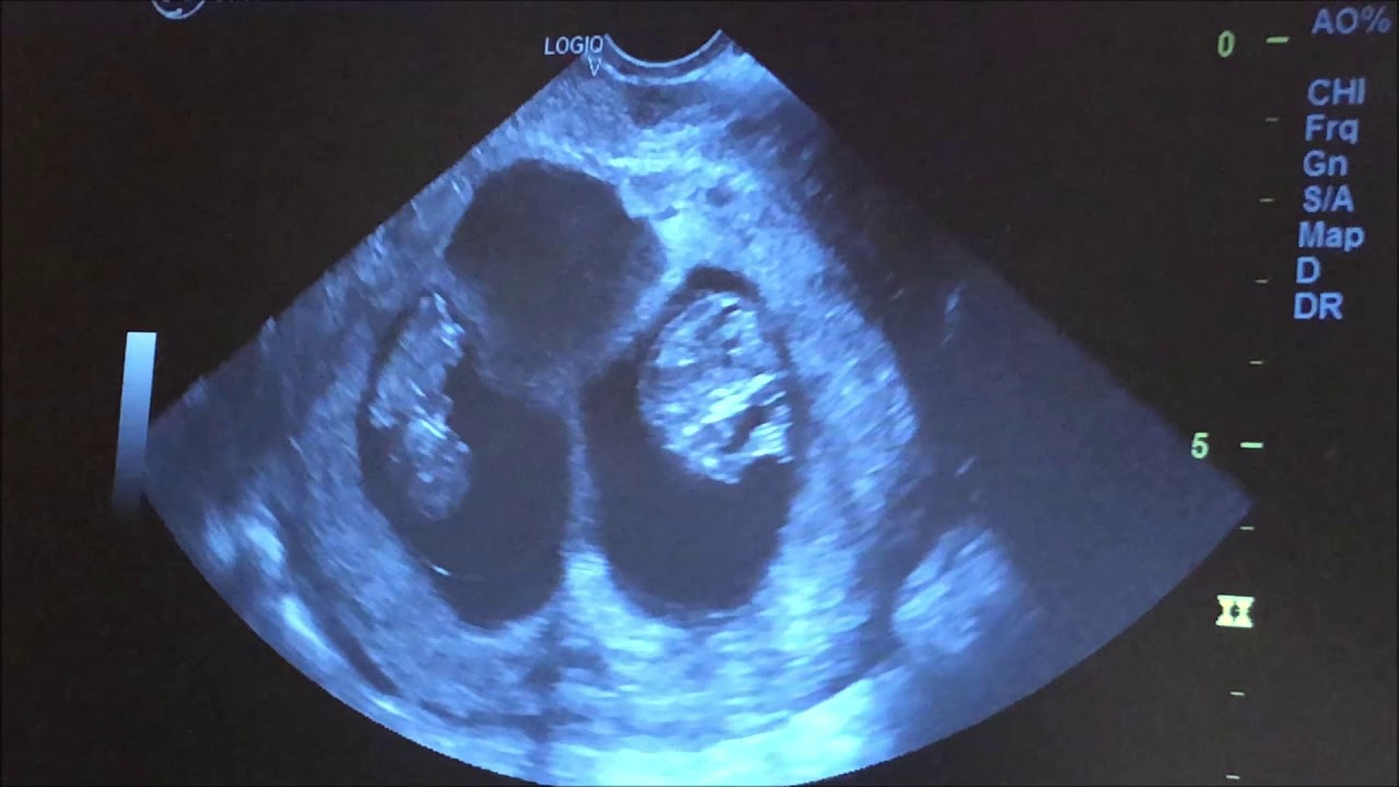 10 week Twin Ultrasound with SCH - YouTube