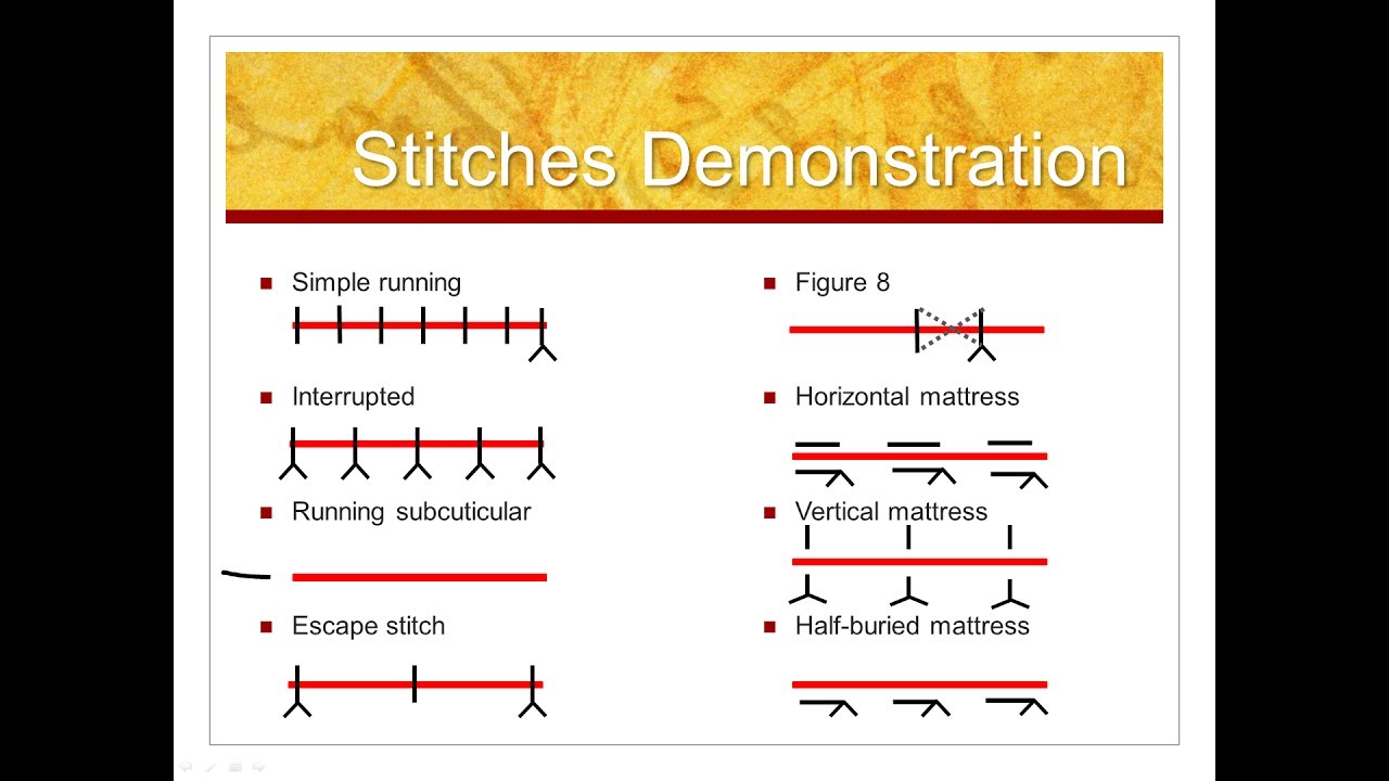 Types Of Stitches Just To Keep You In Stitches Suturi - vrogue.co