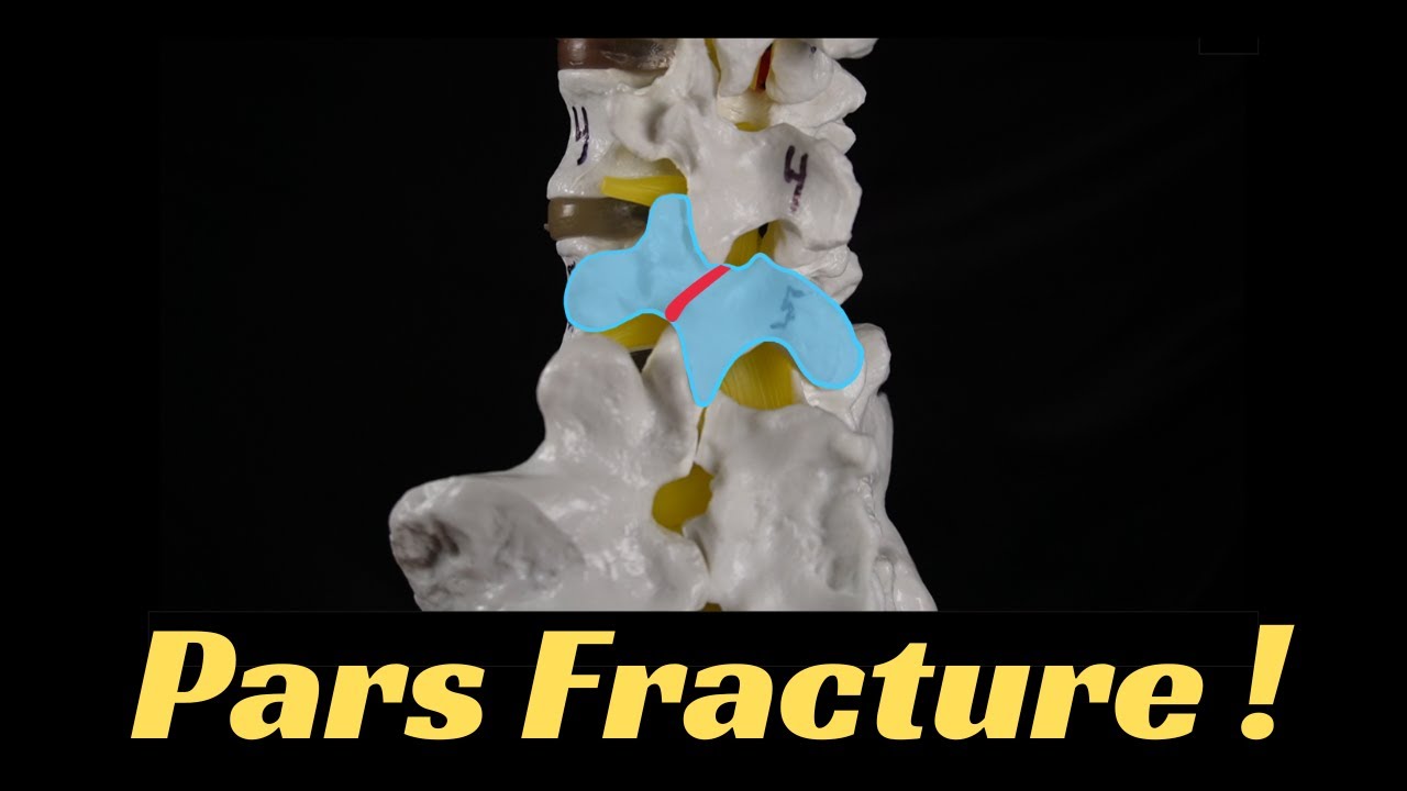 What is a pars fracture? Everything you need to know. - YouTube