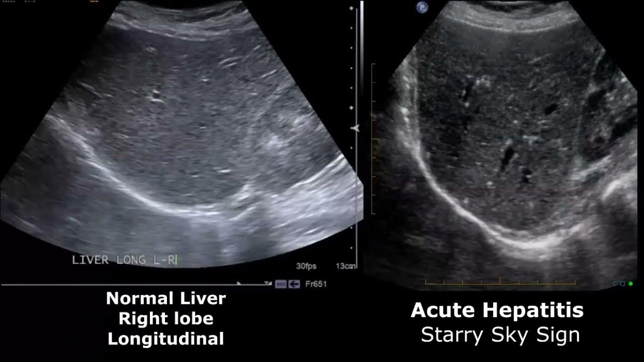 Normal Vs Fatty Liver Ultrasound