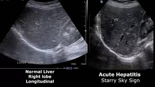 Normal Liver Ultrasound