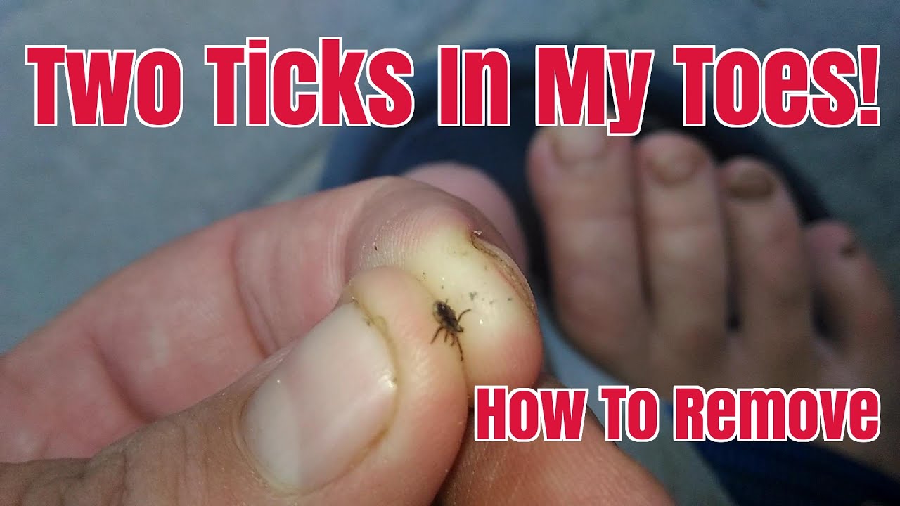 Tick Bite On Top Of Foot Hotsell | emergencydentistry.com