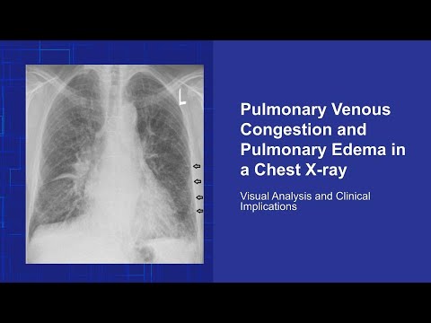 Pulmonary Venous Congestion and Pulmonary Edema in a Chest X-ray - YouTube