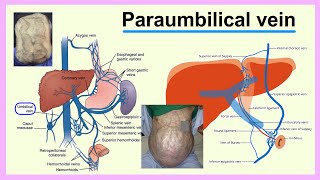 Paraumbilical Vein