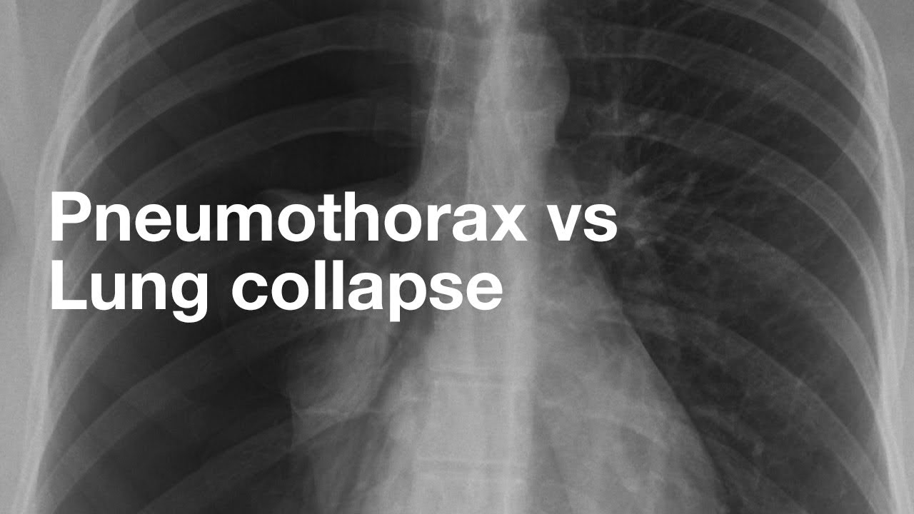 Pneumothorax vs Lung Collapse - YouTube