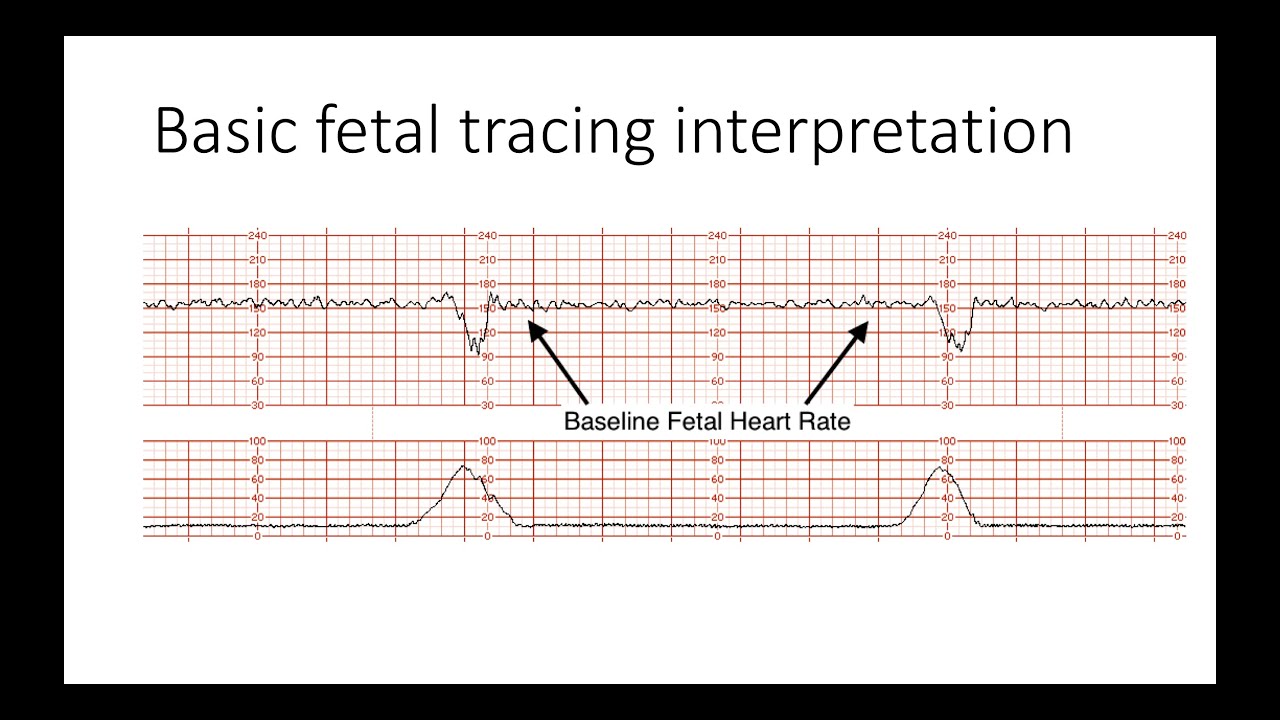 Fetal Heart Rate Patterns