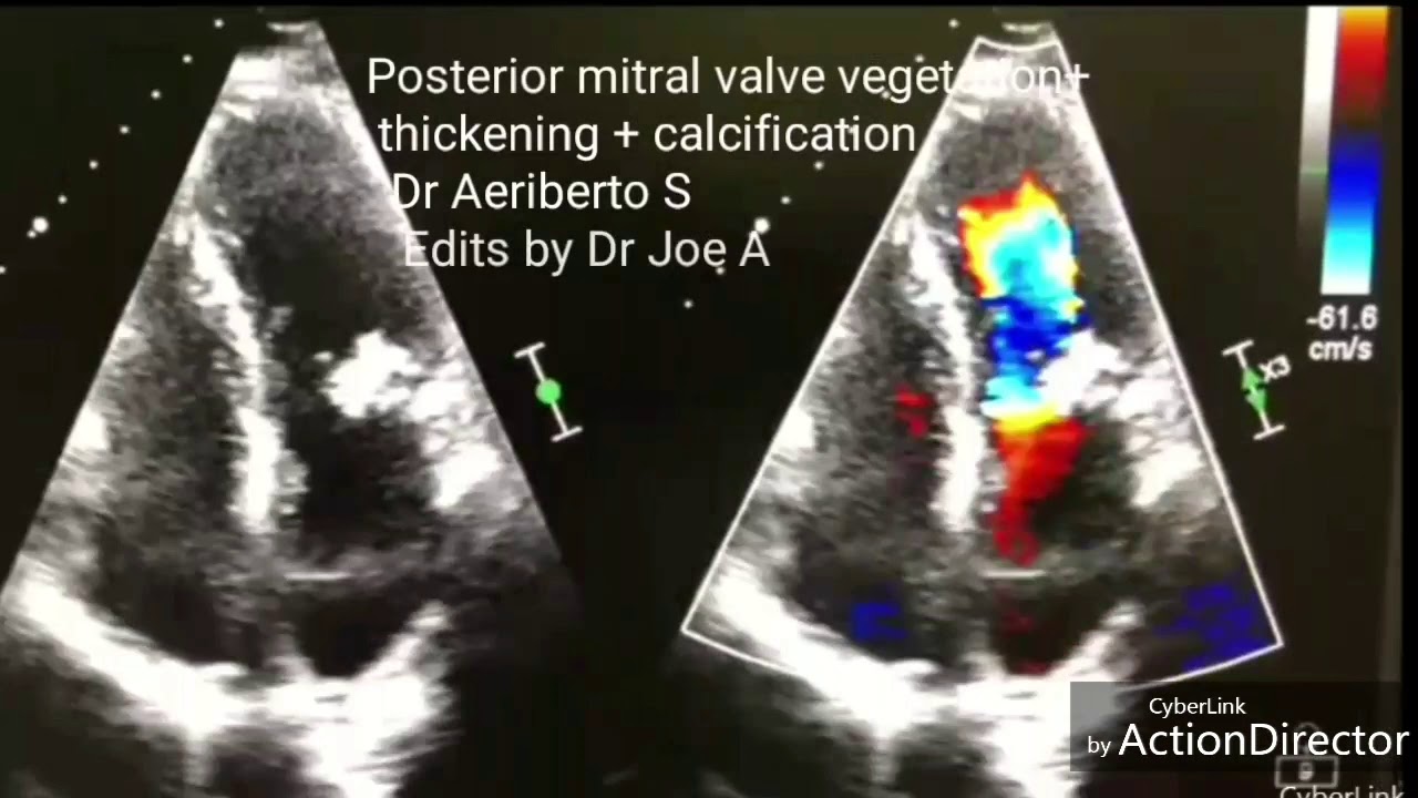 Anterior Mitral Leaflet