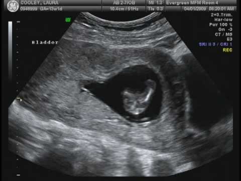 Ultrasound Healthy baby boy 13 weeks - YouTube