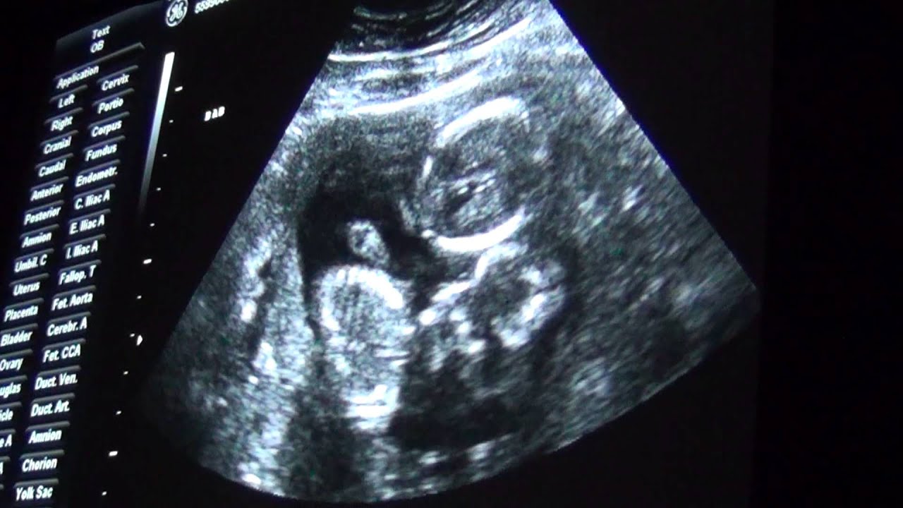 Robincia Twins Gender Ultrasound - YouTube