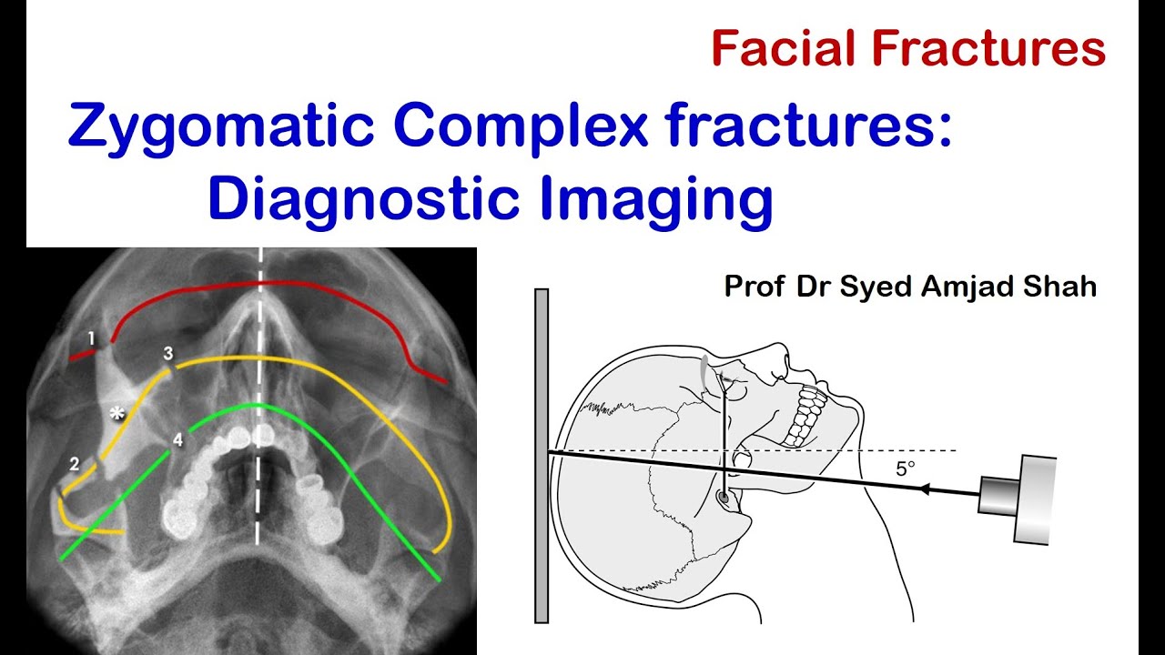 Tripod Fracture