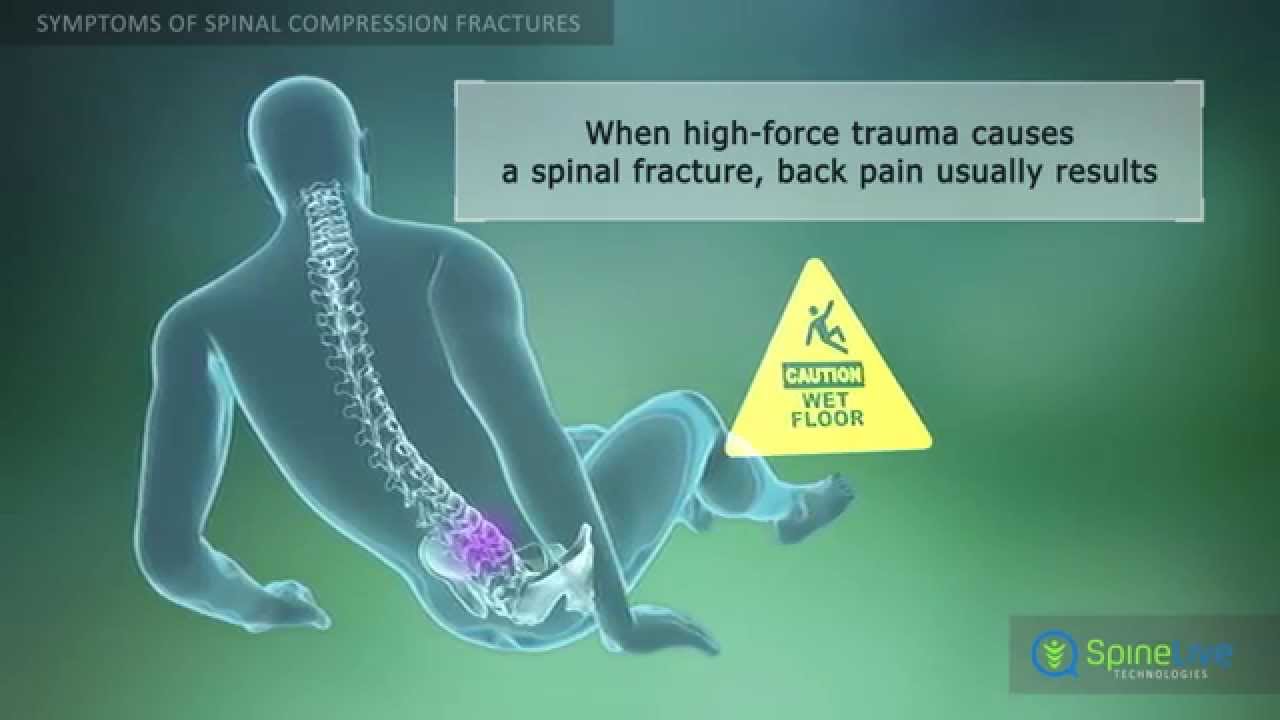 [DIAGRAM] Diagram Of Vertebral Fracture - MYDIAGRAM.ONLINE