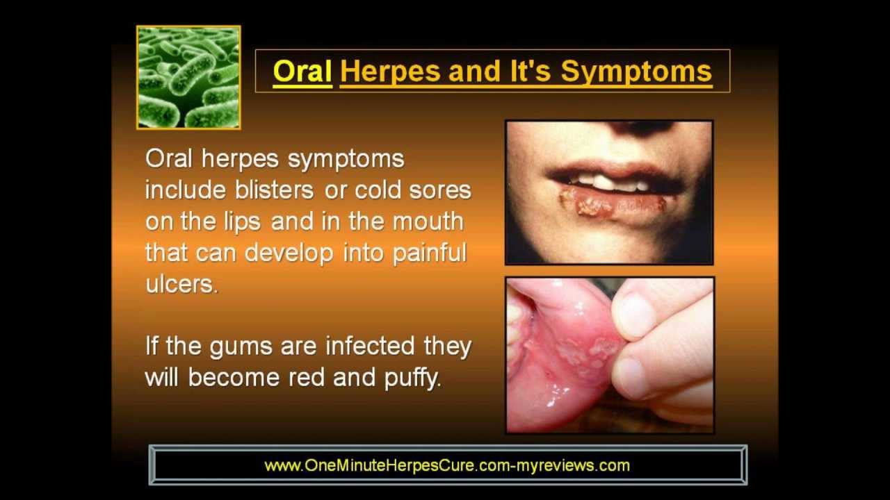 Oral Herpes Symptoms and Causes of Cold Sores