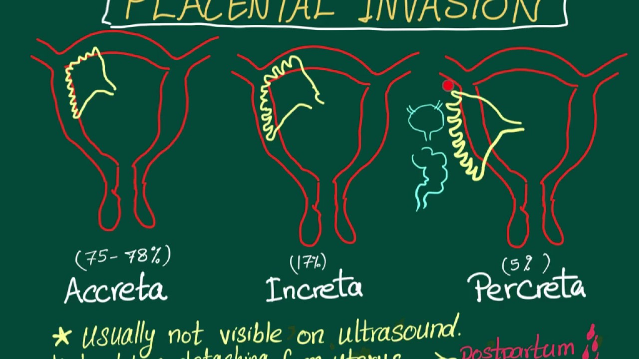 Placenta Acreta Increta E Percreta - RETOEDU