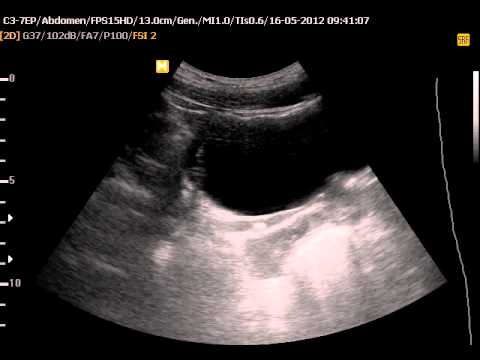 View How To Hold Your Bladder For An Ultrasound PNG - Geoffrey L. Hill