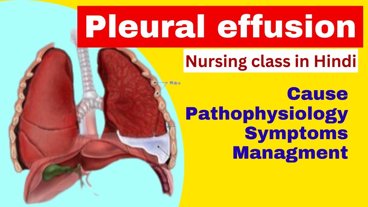 Pleural effusion in hindi | cause, pathophysiology, symptoms ...