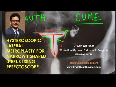 Hysteroscopic Lateral Metroplasty for Narrow T shaped uterus using ...