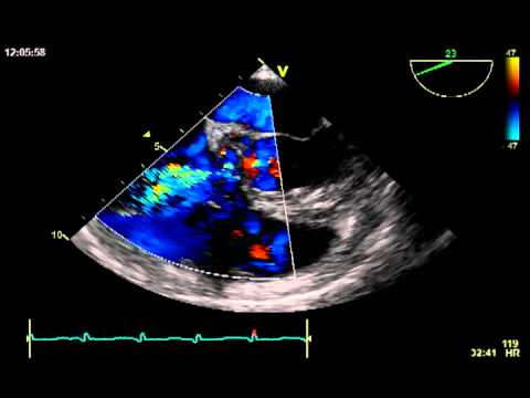 AORTO RIGHT ATRIAL FISTULA - YouTube