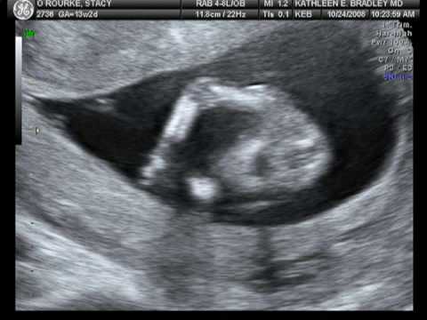 Stacy Ultrasound 13 Weeks 3 Days - YouTube