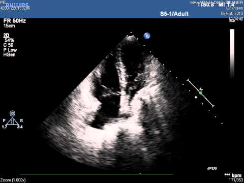 Pulmonary embolism showing McConnells Sign in 2D echo - YouTube